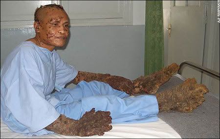 tree man feet. Tree Man Has Surgery,